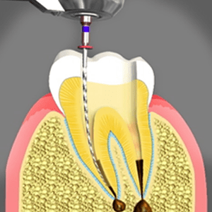 Root Canal Treatment from an endodontist in Raleigh NC